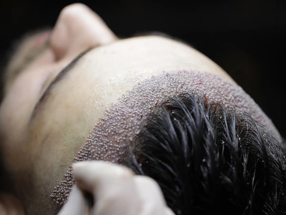 Wonder Hairs Saç Ekim Merkezi